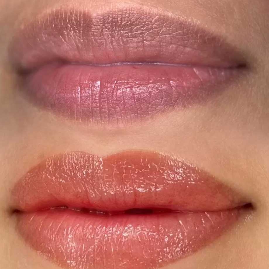 Lip Neutralisation before and after — example 3