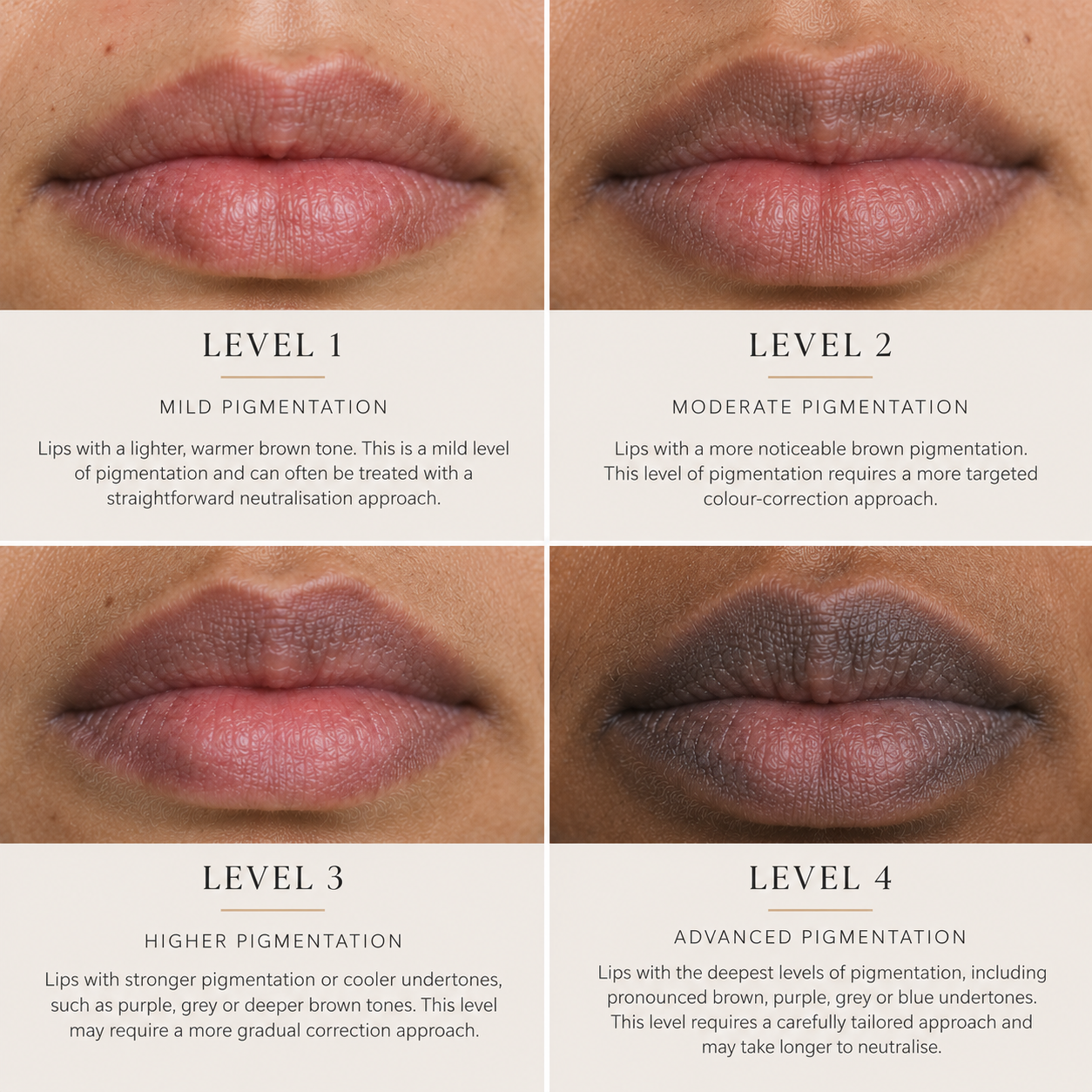Four levels of lip pigmentation, from mild warm brown at level 1 to advanced brown, purple, grey or blue undertones at level 4