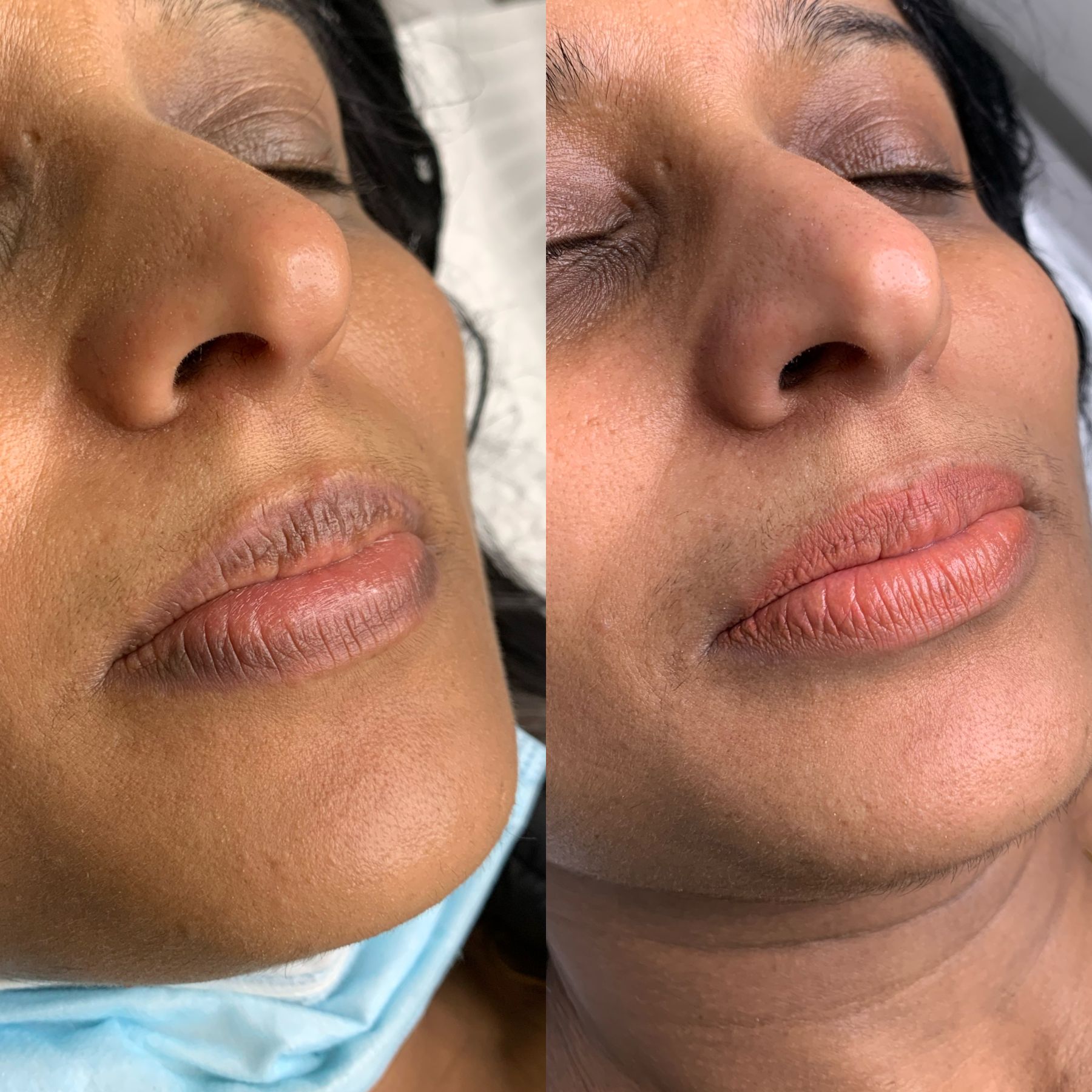 Lip Neutralisation before and after — example 1